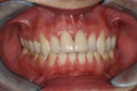 Porcelain Veneers After