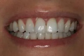 Patient 11 After (Non Vital Tooth Whitening)