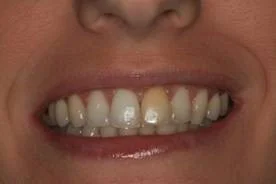 Patient 11 Before (Non Vital Tooth Whitening)