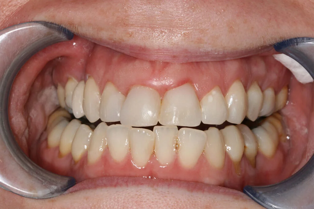 Patient 2 After (KöR Whitening)