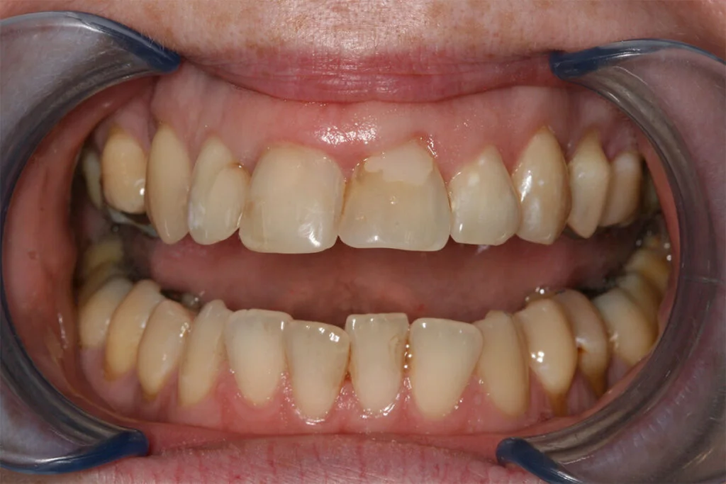 Patient 2 Before (KöR Whitening)