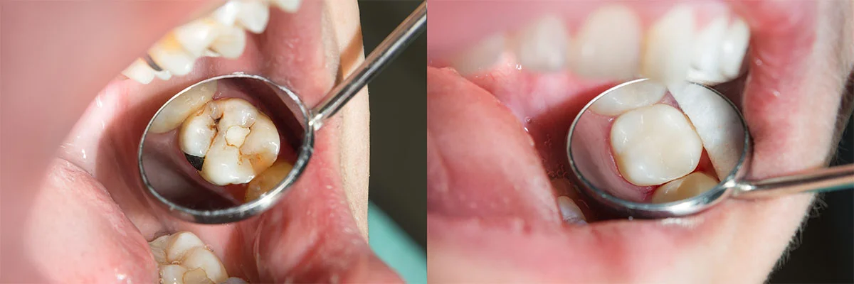 Human teeth close-up during restoration of filling. The concept of aesthetic dentistry
