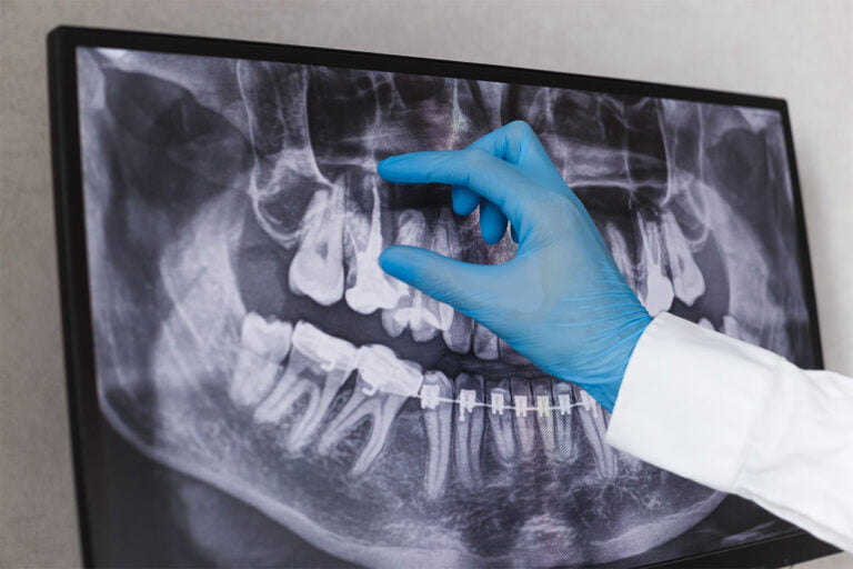 Doctor points to filled root canal in dental x-ray.