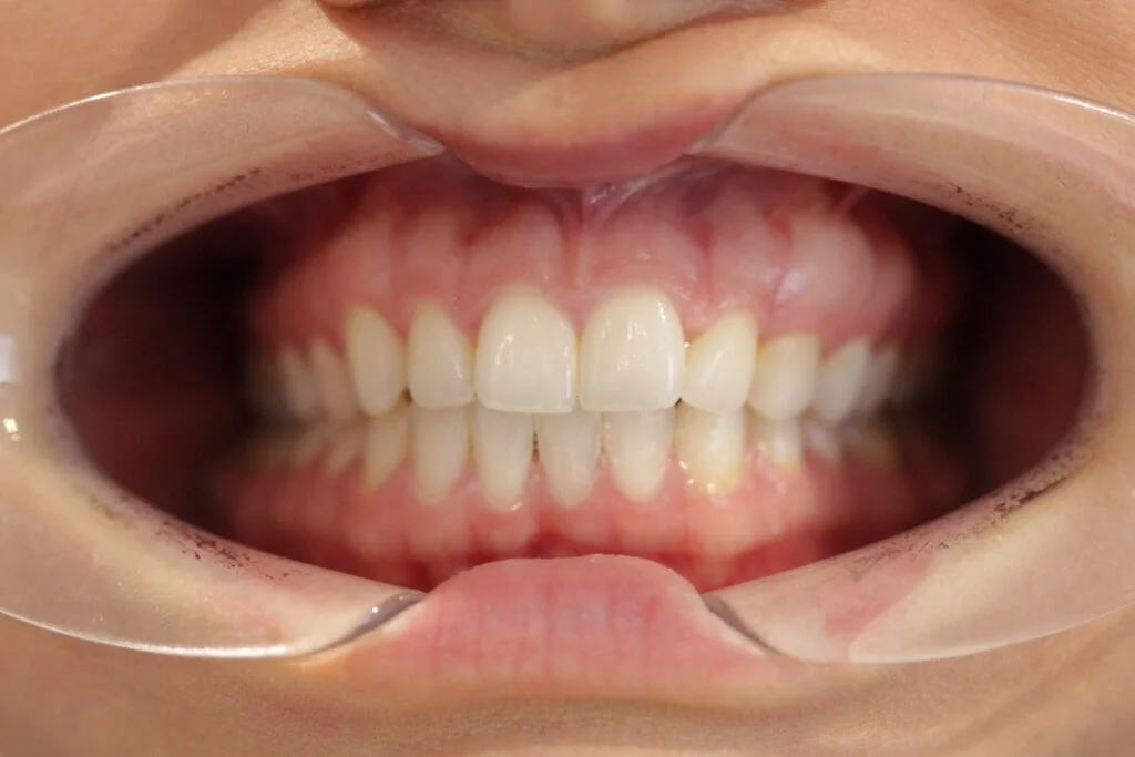 After Teeth Whitening