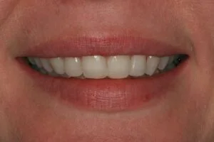 ABB After