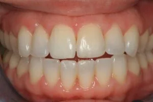 ABB After