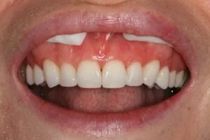 Edge Bonding After