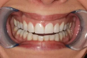 Composite Bonding After
