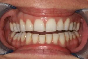 Composite Bonding Before