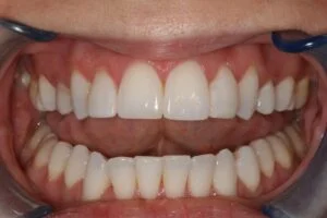Diastema Closure After
