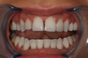 Diastema Closure Before
