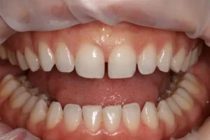 Diastema Closure Before