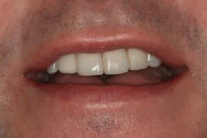 Implant After