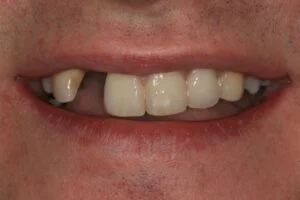Implant Before