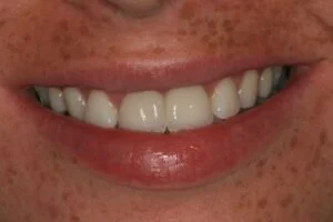 Implant After