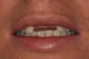 Implant Before