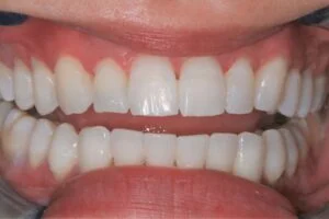 KöR Whitening After