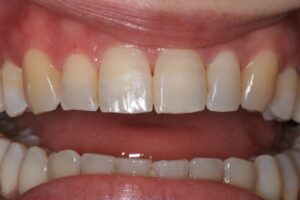 KöR Whitening Before