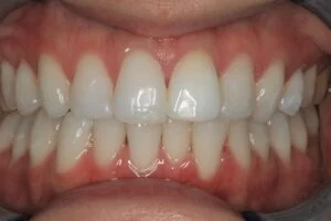 Non Vital Whitening After