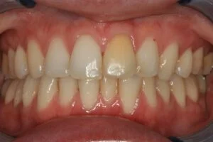 Non Vital Whitening Before