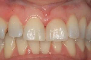 Veneer After