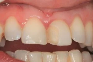 Veneer Before