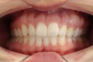 Home Teeth Whitening After