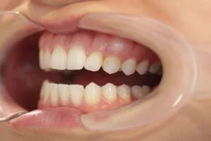 Home Teeth Whitening After
