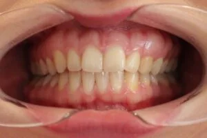 Home Teeth Whitening Before