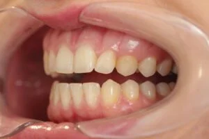 Home Teeth Whitening Before