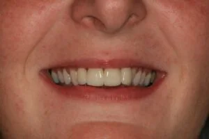 Crowns After