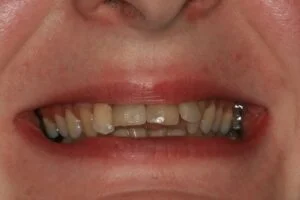 Crowns Before