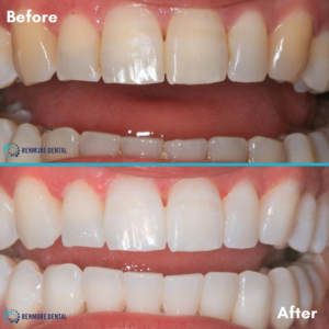 Before and After Whitening 