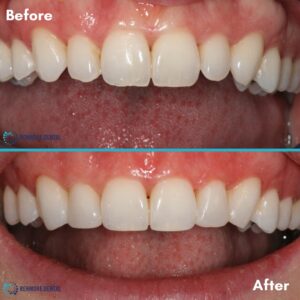 Edge bonding to close minor spaces
