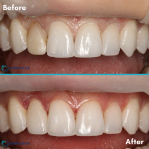 Before and After Dental Crowns 