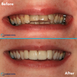 Before and After showing results of dental crown treatment 