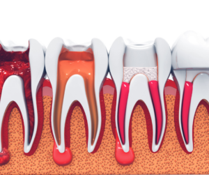 Root Canal Treatment