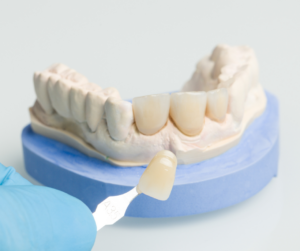 Dental Veneers